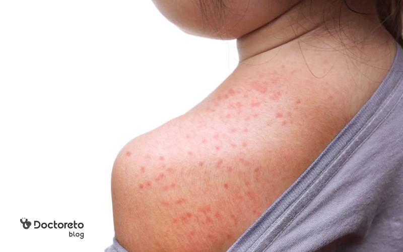عکس بثورات پوستی در کودکان