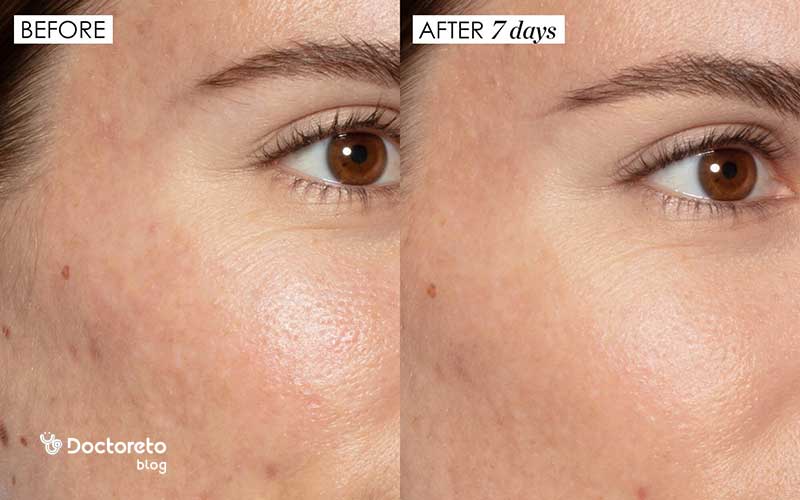 عوارض اسید تراپی صورت چیست؟