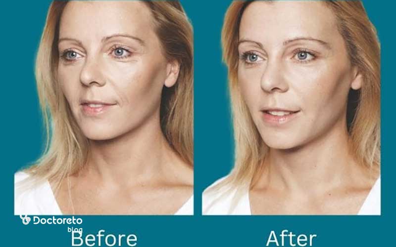 عکس قبل و بعد اسید تراپی برای لک چگونه است؟