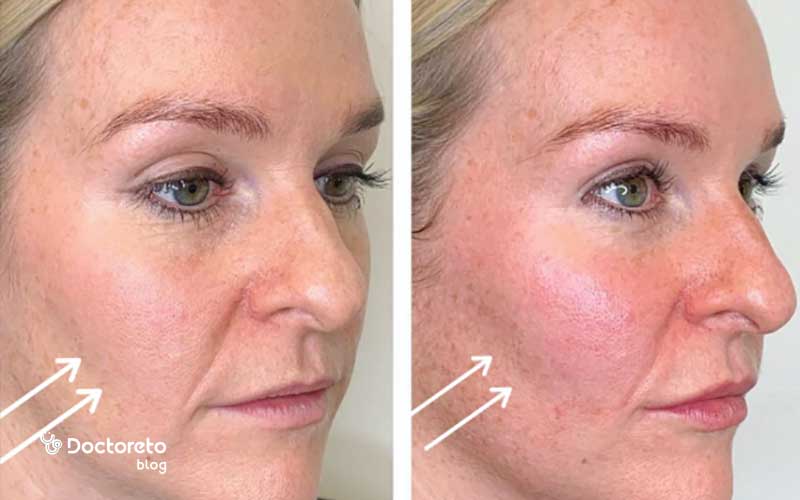 عکس قبل و بعد اسید تراپی صورت چگونه است؟
