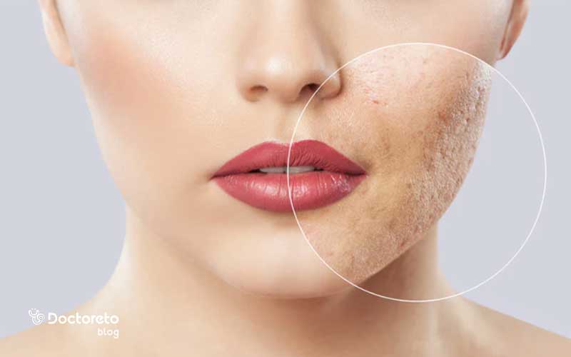 عوارض اسید تراپی برای جوش چیست؟