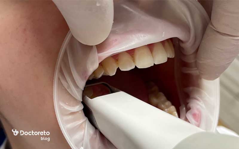 قالب‌گیری دندان برای روکش به روش دیجیتال چگونه است؟