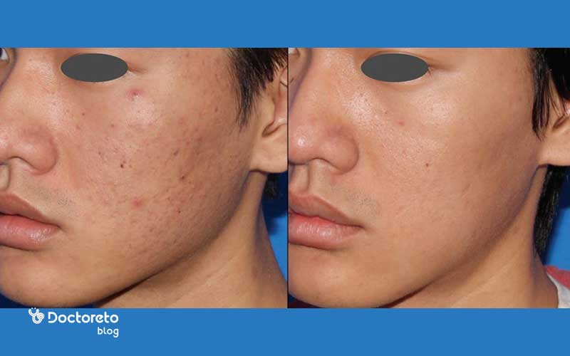 کاربردهای میکرونیدلینگ برای جای جوش چقدر موثر است؟