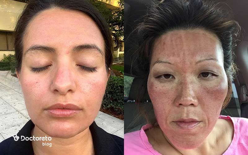 عکس لک بعد از میکرونیدلینگ بدین شکل است.