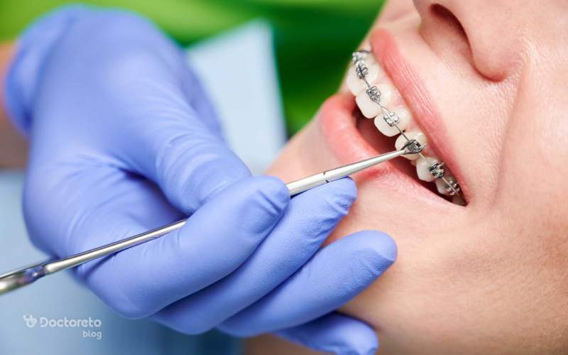 مراحل ارتودنسی بزرگسالان چگونه است؟