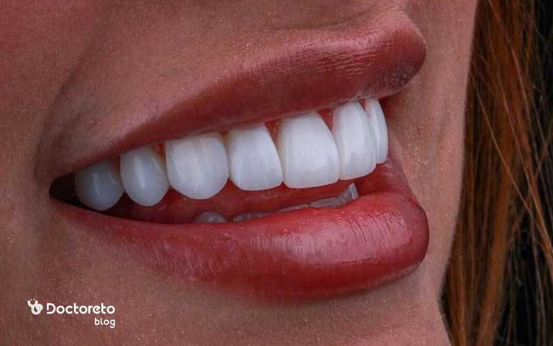 برای طولانی کردن عمر دندان زیرکونیا چگونه باید از آن مراقبت کرد؟