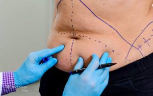 جراحی زیبایی شکم و هر آنچه باید درباره آن بدانید