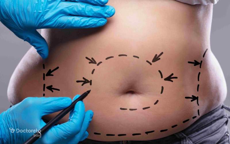 کاربردهای جراحی زیبایی شکم چیست؟