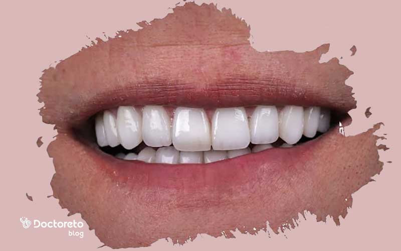 عوارض قالب گیری دندان برای روکش چیست؟