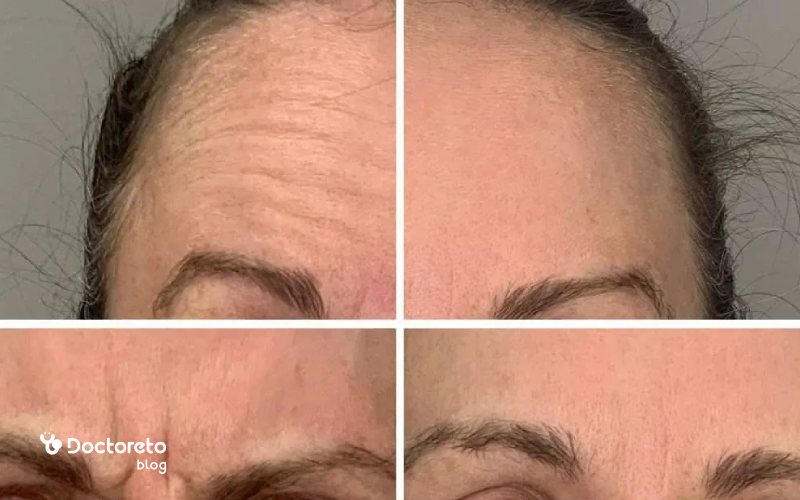 بوتاکس صورت از چند سالگی انجام میشود؟