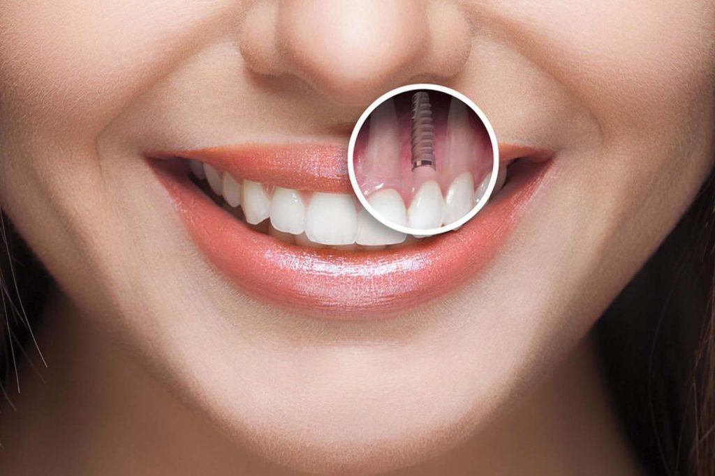 کاشت دندان چه آمادگی هایی نیاز دارد؟