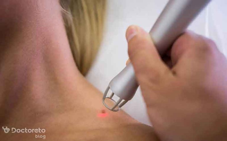 برداشتن خال با لیزر برای چه افرادی مناسب است؟