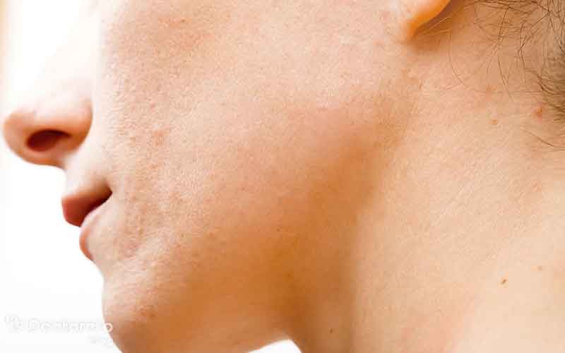 برداشتن خال با لیزر چیست؟