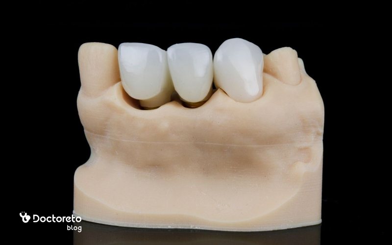 روش اعمال چسب چه تاثیری در عمر روکش دندان دارد؟