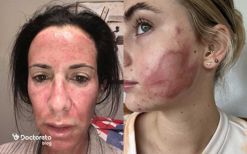 عکس سوختگی بعد از میکرونیدلینگ بدین شکل است. 