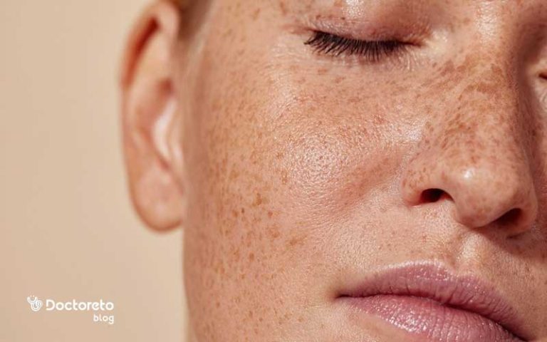 آیا میکرونیدلینگ برای لک صورت درمانی مؤثر است؟