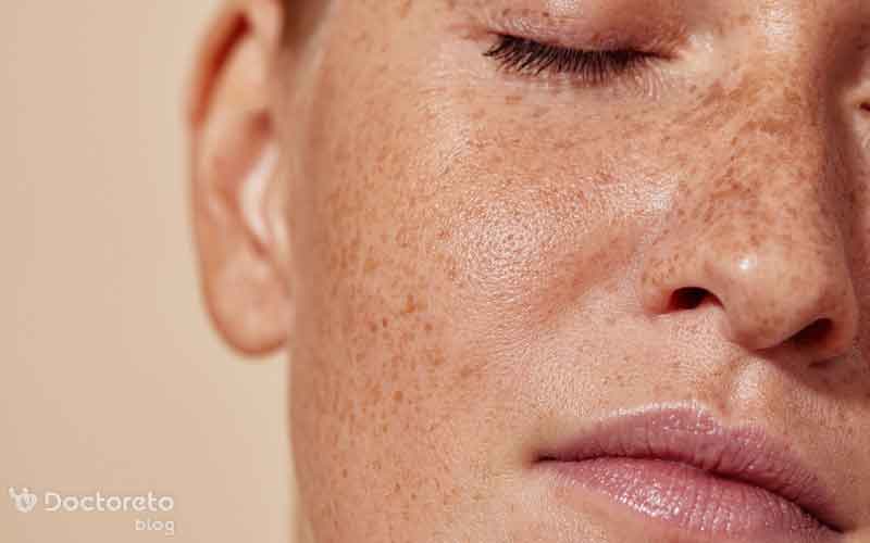 روش های رفع لک صورت چیست؟