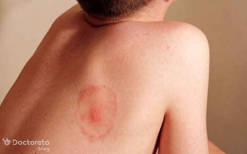 جوش پشت کمر نشانه چیست و چگونه درمان می‌ شود؟