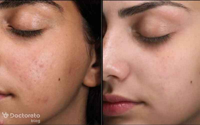 عکس فیشیال صورت قبل و بعد بدین شکل است.