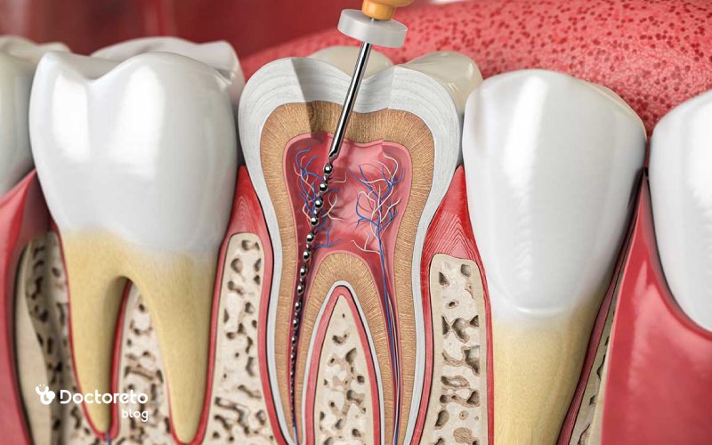 بهترین روکش دندان عصب کشی شده چیست؟