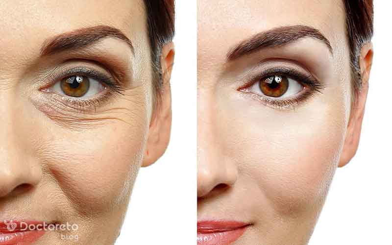عکس قبل و بعد کربوکسی تراپی