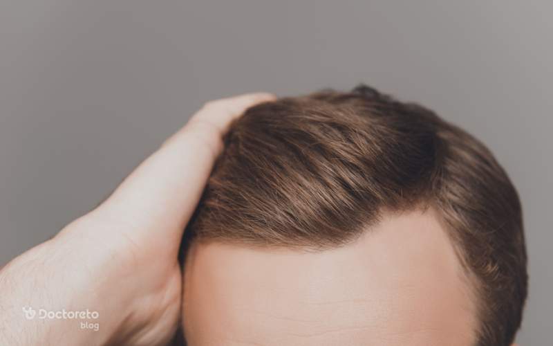 نکات مهم تغذیه ای بعد از کاشت مو چیست؟