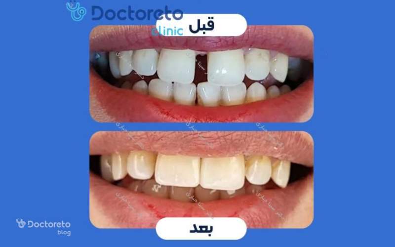 انجام کامپوزیت چه عوارضی دارد؟