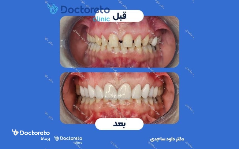 عکس دندان تراش خورده برای کامپوزیت