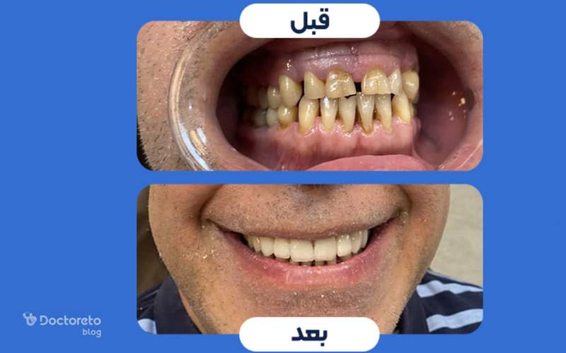 عکس قبل و بعد کامپوزیت دندان جلویی چگونه است؟