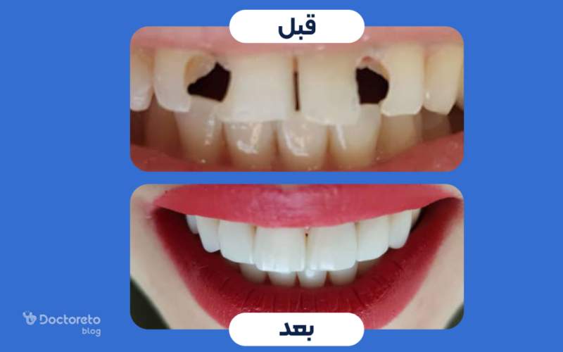 عکس قبل و بعد کامپوزیت دندان ترک خورده و شکسته چگونه است؟