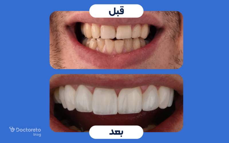 عکس قبل و بعد کامپوزیت دندان بعد تغییر رنگ شدید چگونه است؟