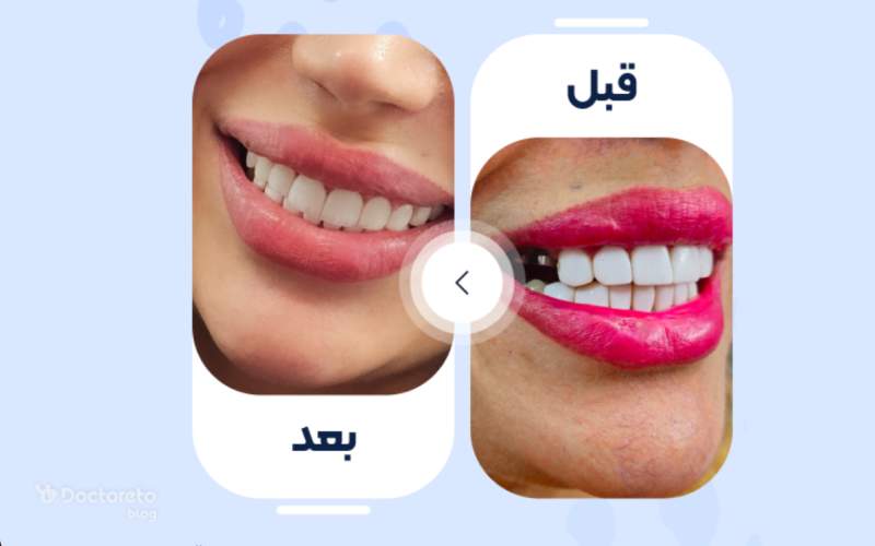 عکس قبل و بعد کامپوزیت دندان خلفی چگونه است؟