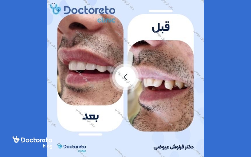 عکس کامپوزیت دندان کج