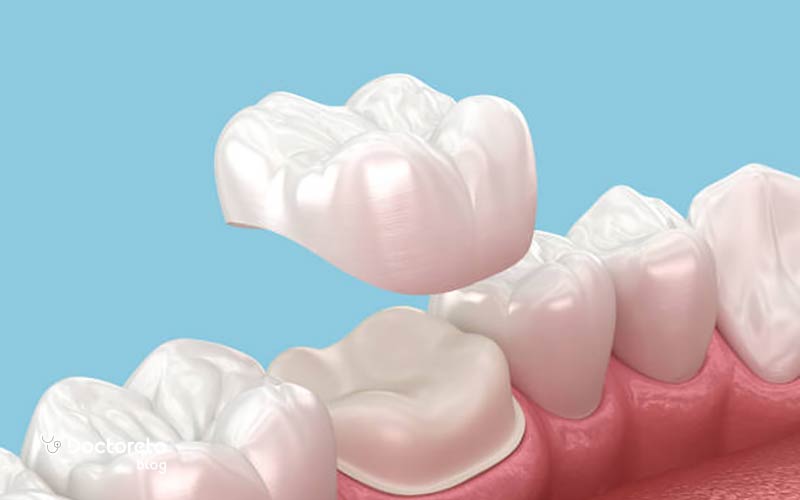 عکس تراش دندان برای روکش چگونه است؟