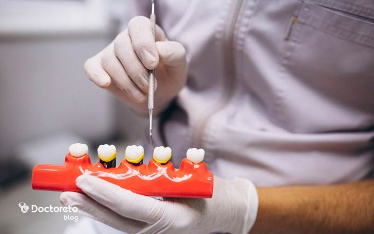 روکش دندان بدون پایه چیست و چه تفاوتی با سایر روکش ها دارد؟