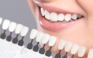 آیا میشود رنگ روکش دندان را تغییر داد؟