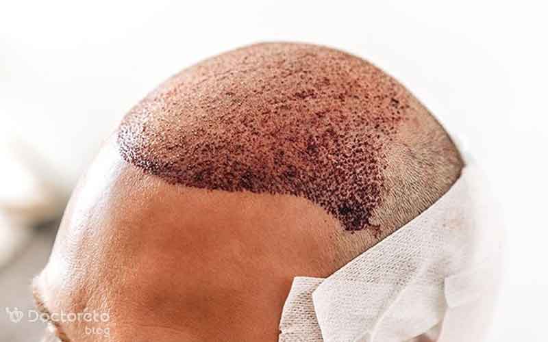 مراقبت بعد از کاشت مو چگونه است؟