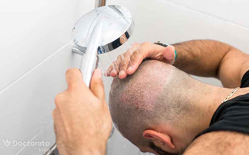 مراقبت های بعد از کاشت مو چیست؟