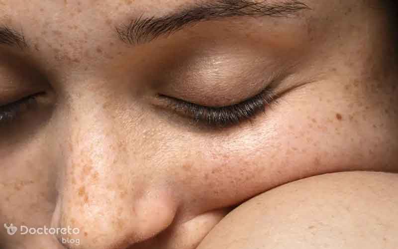 لک صورت چه ظاهری دارد؟