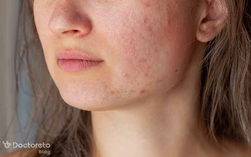 مصرف برخی داروها دلیل بروز لک صورت است؟