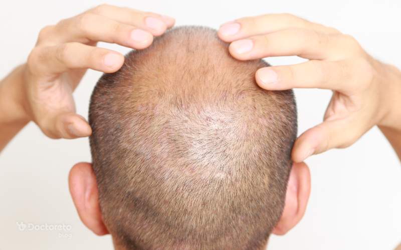 روش ‌های مناسب مصرف پیاز بعد از کاشت مو چیست؟