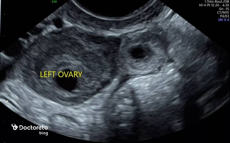عکس سونوگرافی بارداری خارج از رحم