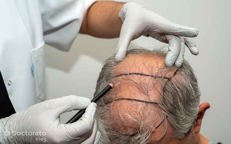 کاشت مو بدون تراشیدن سر چگونه انجام می شود؟