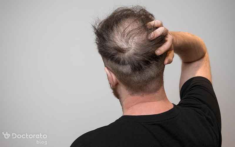معایب کاشت مو به روش میکروگرافت چیست؟