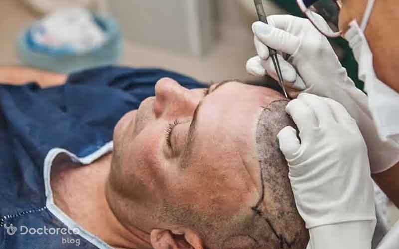 کاشت مو به روش میکروگرافت چیست؟