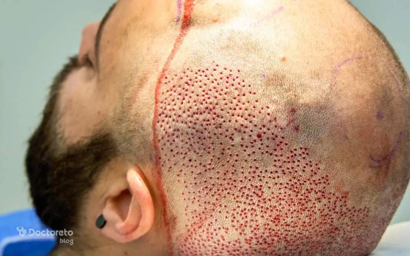 زمان رعایت نحوه خواب بعد از کاشت مو چگونه است؟