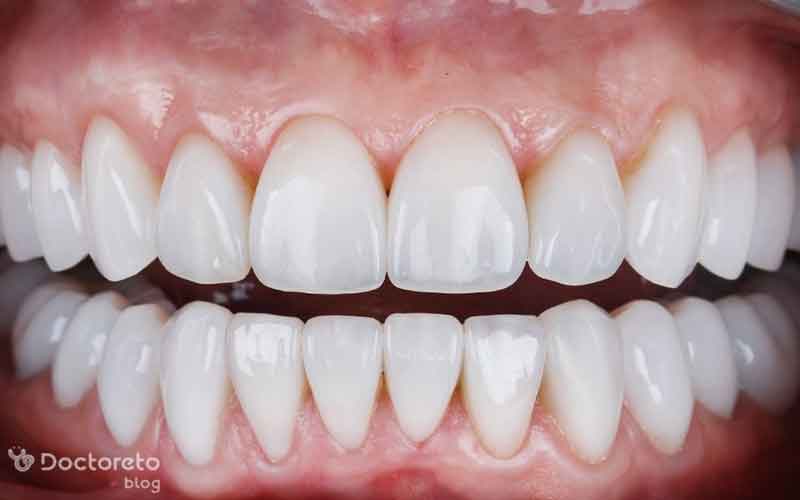 سلامت لثه یکی از عوامل تعیین کننده فاصلی بین عصب کشی و روکش دندان است.