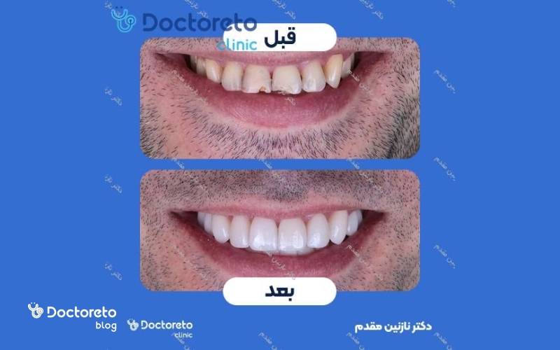 عکس کامپوزیت دندان مردانه قبل و بعد