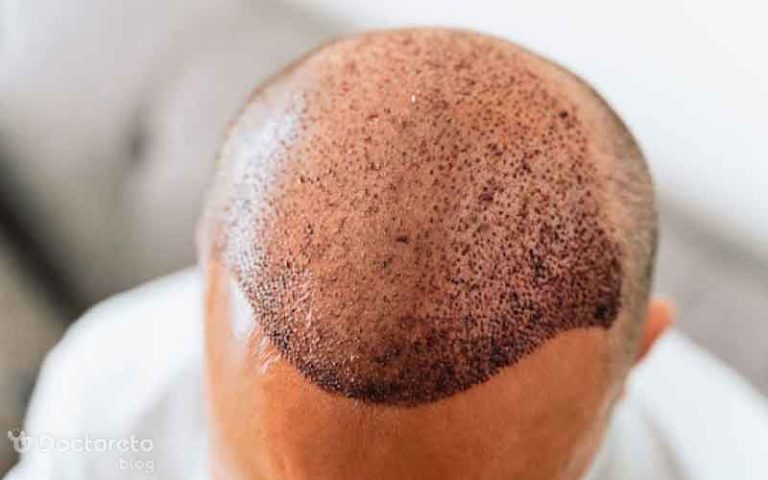 دلایل پشت پرده ریزش مو بعد از کاشت