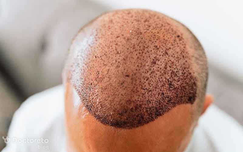 ریزش مو بعد از کاشت را چگونه درمان کنیم؟